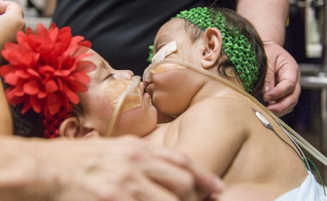 Conjoined twins separated at Texas Children`s Hospital